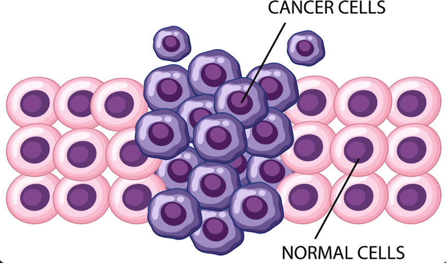 Lymphoma diagnosis and staging procedures infographic with biopsy imaging tests and cancer staging classification methods