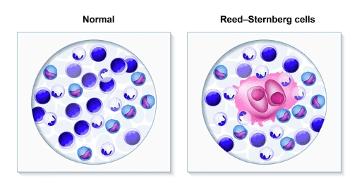 Lymphoma symptoms and warning signs infographic with swollen lymph nodes fatigue fever and unexplained weight loss indicators
